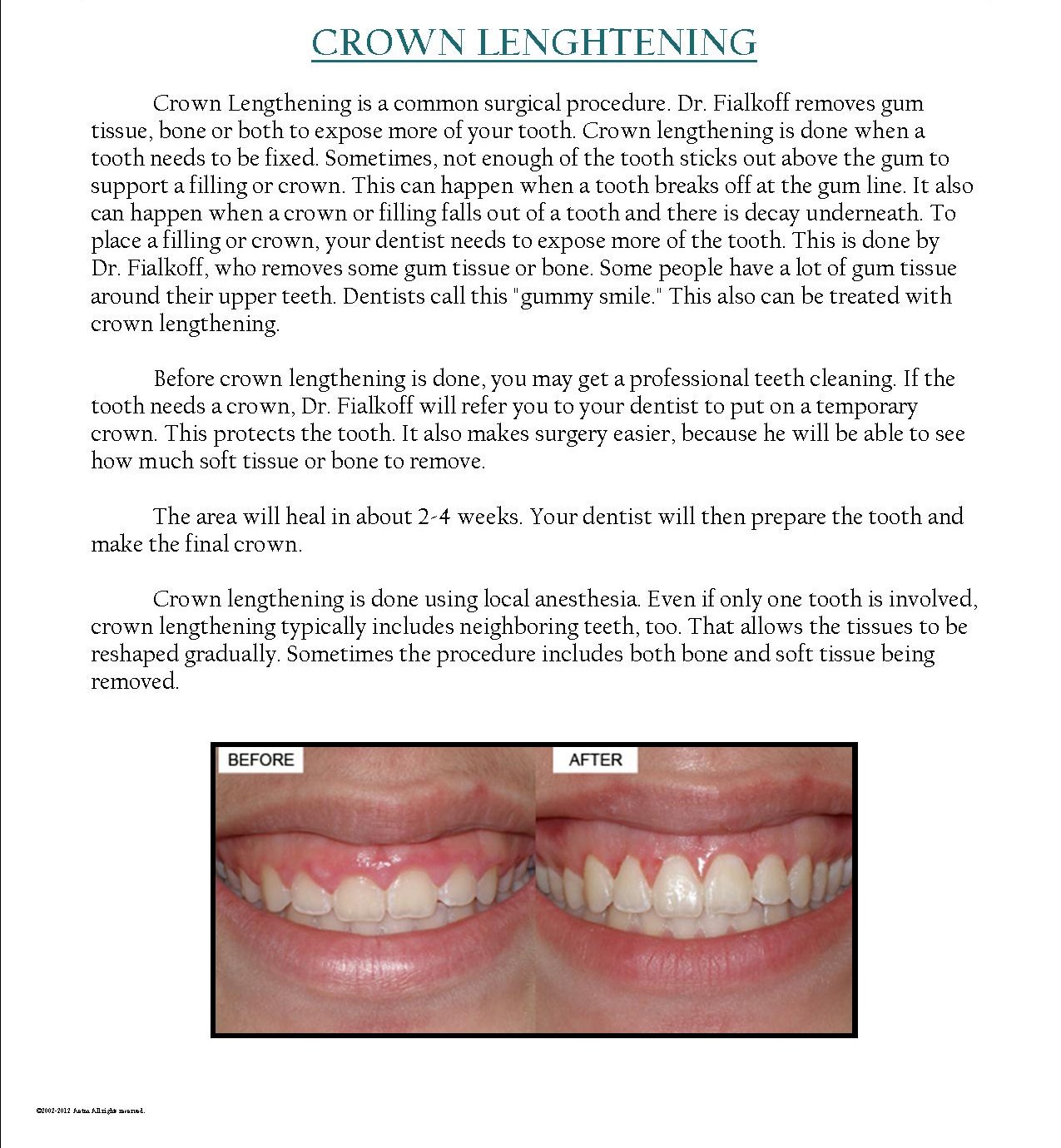How Much Is A Crown >> Dr Bernard Fialkoff Crown Lengthening Dr Bernard Fialkoff How Much Is A Crown >> Dr Bernard Fialkoff Crown Lengthening Dr Bernard Fialkoff